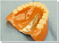 レジンと金属の入れ歯の比較