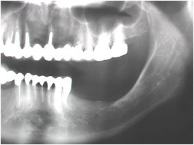 術前の口腔内レントゲン画像