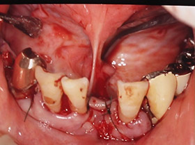 歯槽膿漏の手術